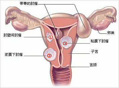 宫颈肿瘤