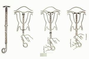 莎车避孕环怎么取(取避孕环后要注意什么)