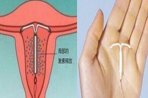 阿图什上环术(上环手术过程)