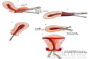 阿图什上环怎么上(女性上环去医院的流程)