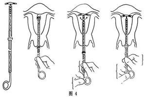 阿图什为什么上环(上环复杂吗)